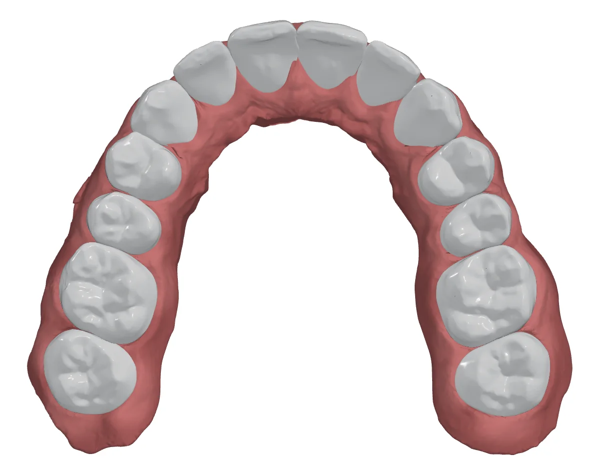Upper arch after AI Setup