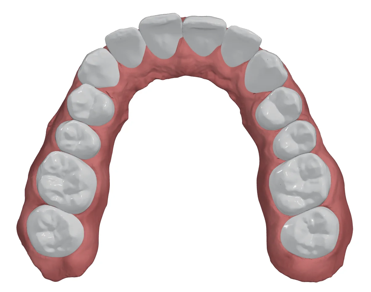 Upper arch before AI Setup