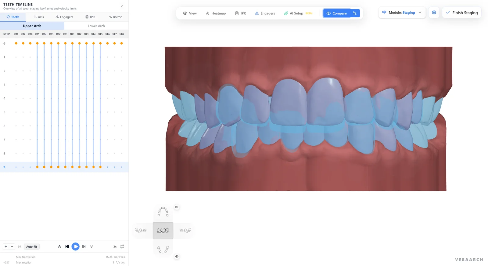 Staging module comparing start and target tooth positions in frontal view